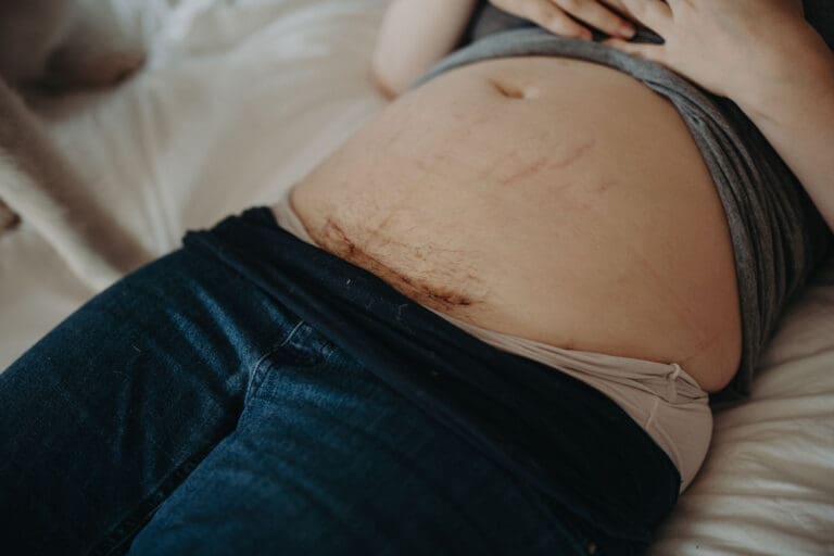 Mother with a C-section birth scar